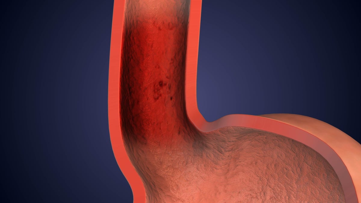 Representación anatómica del estómago mostrando diferencias entre gastritis y úlcera