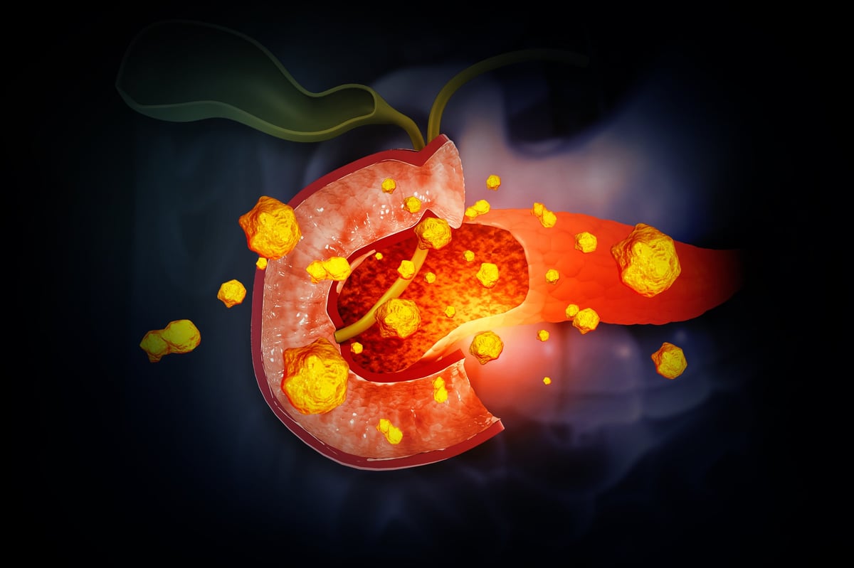 Ilustración 3D de vesícula biliar con cálculos, concepto de colecistitis y piedras en la vesícula